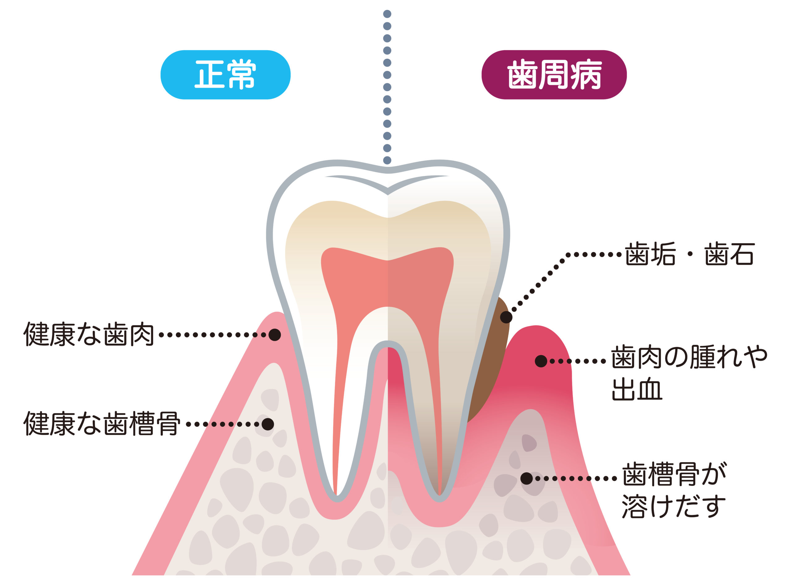 歯周病の原因と大切な予防歯科 | デンタルコラム | おくだ歯科医院 - 歯周病・インプラントセンター