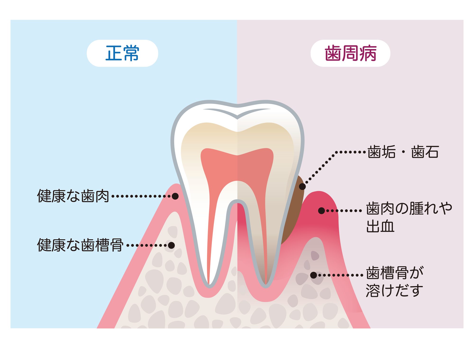  1 型糖尿病の治療薬