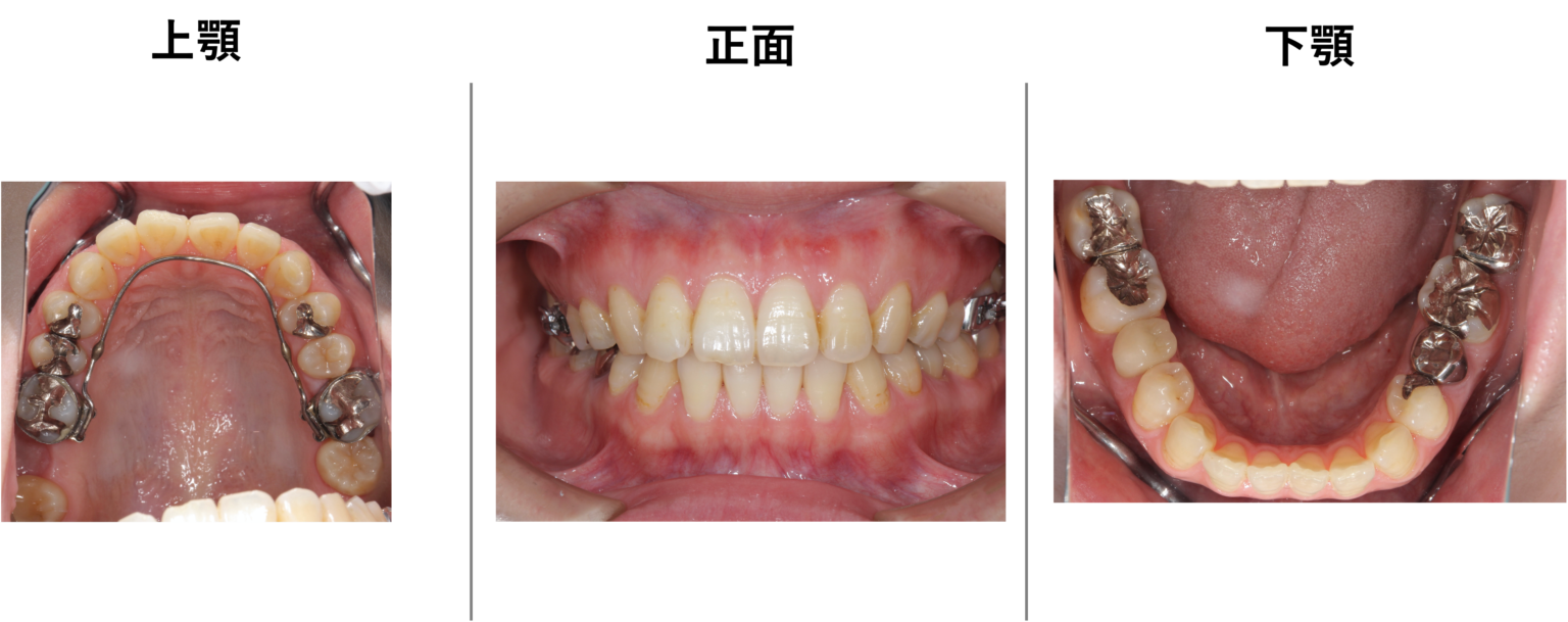 【症例画像有】歯医者が教える正しい治療の順番 | デンタルコラム | おくだ歯科医院 - 歯周病・インプラントセンター