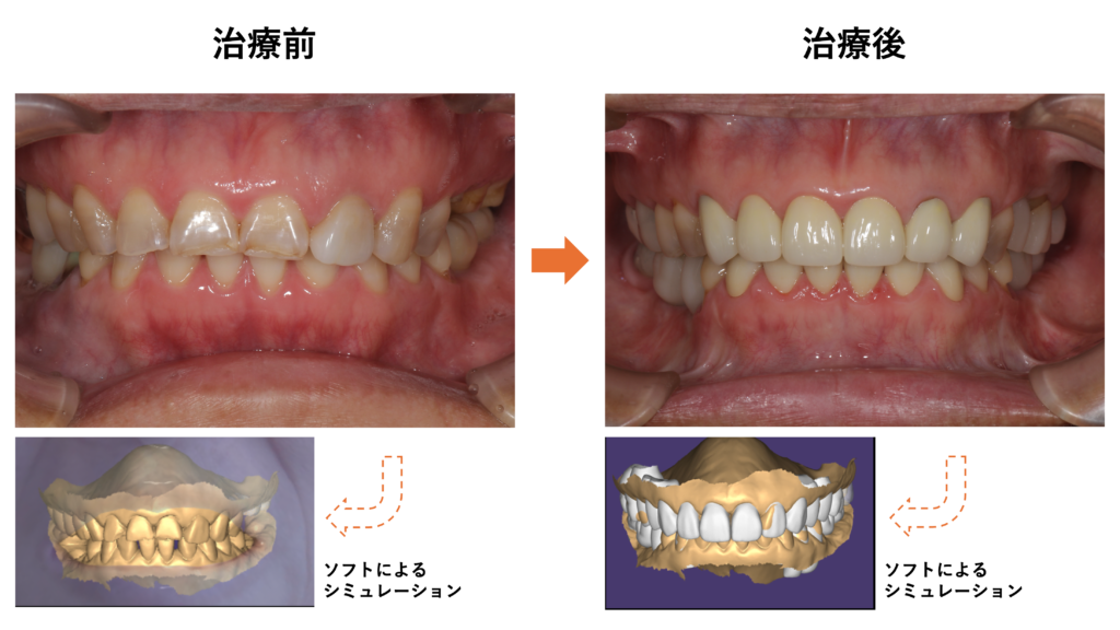 実際のお口の中と、ソフトによるシミュレーション画像の比較